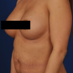Tummy Tuck Before & After Patient #240