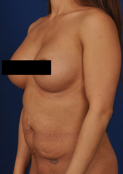 Tummy Tuck Before & After Patient #240
