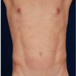 Torso Liposuction Before & After Patient #292