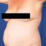 Tummy Tuck Before & After Patient #237