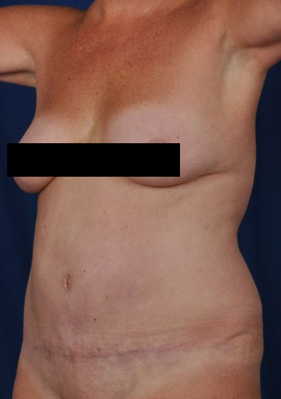 Tummy Tuck Before & After Patient #237