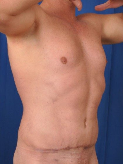 Are 6-pack Abs Possible after a Male Tummy Tuck? Yes, They Are