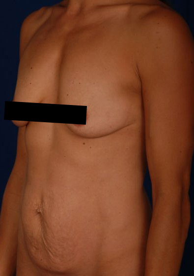 Torso Liposuction Before & After Patient #234