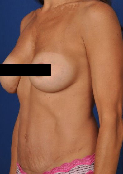 Torso Liposuction Before & After Patient #234