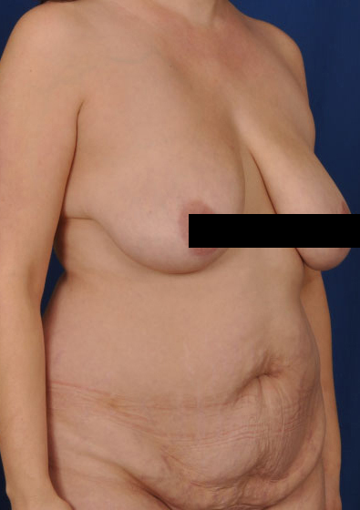 Tummy Tuck Before & After Patient #229