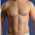 Torso Liposuction Before & After Patient #284