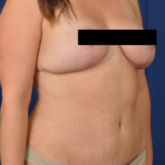 Tummy Tuck Before & After Patient #229