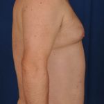 Torso Liposuction Before & After Patient #265
