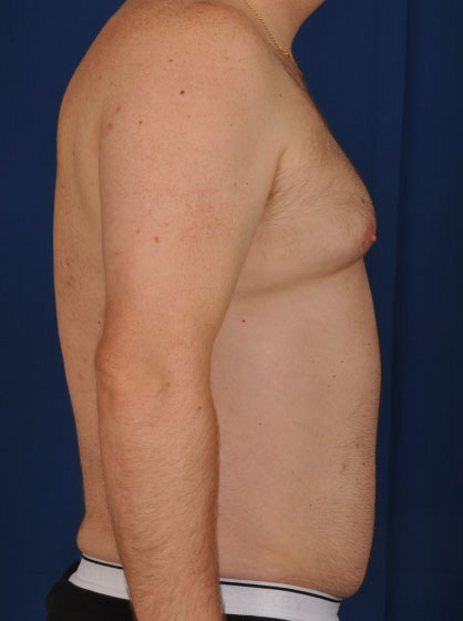 Torso Liposuction Before & After Patient #265