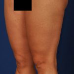 Legs Liposuction Before & After Patient #213