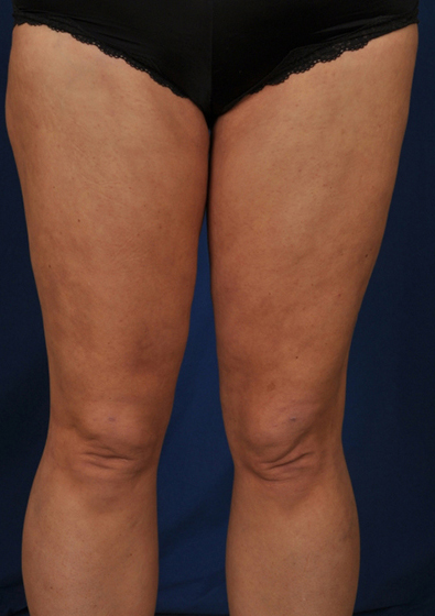 Legs Liposuction Before & After Patient #213