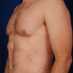 Torso Liposuction Before & After Patient #260