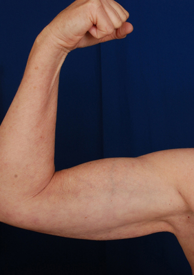 Arms Liposuction Before & After Patient #207