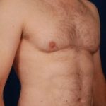 Torso Liposuction Before & After Patient #260
