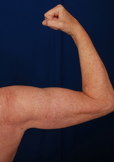 Arms Liposuction Before & After Patient #202