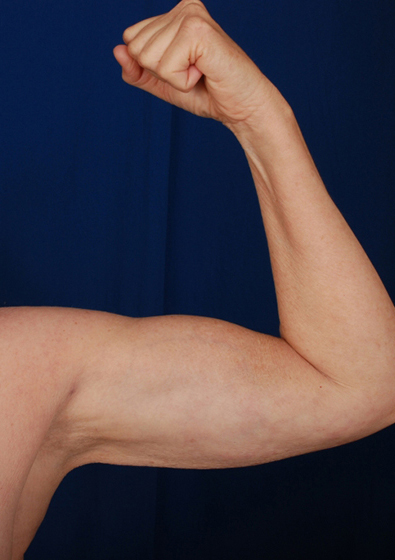 Arms Liposuction Before & After Patient #207