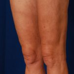 Legs Liposuction Before & After Patient #184