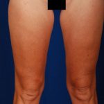 Legs Liposuction Before & After Patient #184