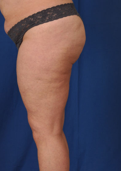 Legs Liposuction Before & After Patient #179