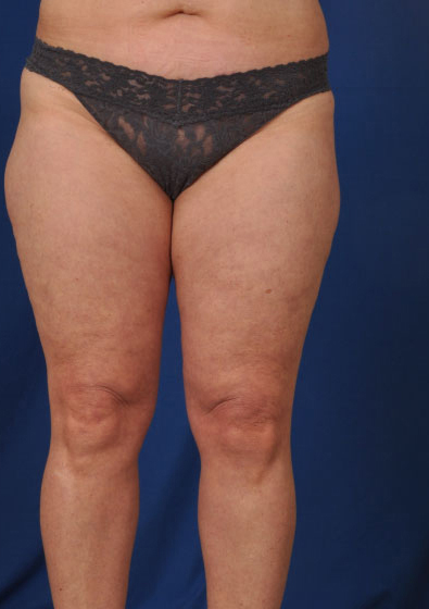 Legs Liposuction Before & After Patient #179