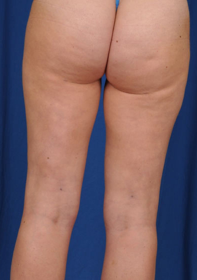 Legs Liposuction Before & After Patient #174