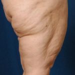 Legs Liposuction Before & After Patient #162