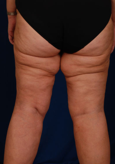 Legs Liposuction Before & After Patient #162