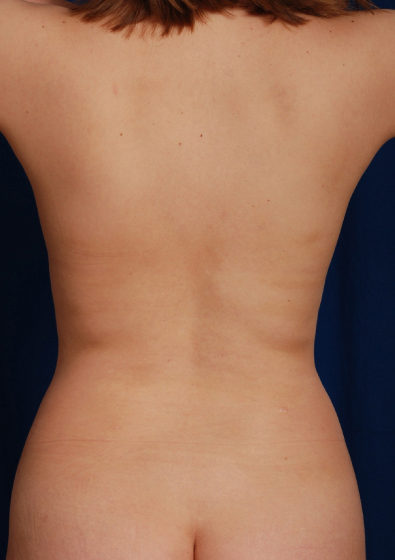 Torso Liposuction Before & After Patient #144