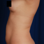 Torso Liposuction Before & After Patient #144