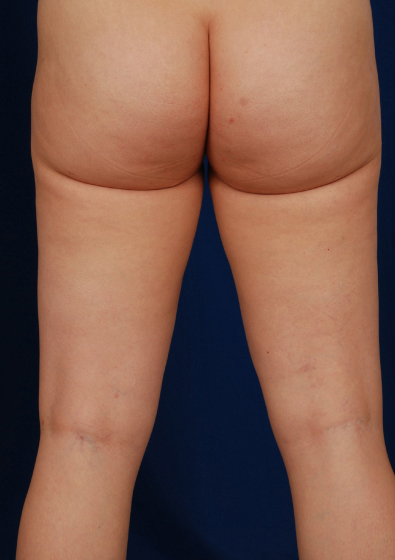 Legs Liposuction Before & After Patient #112
