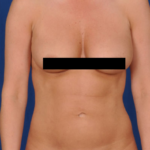 Torso Liposuction Before & After Patient #133