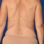 Torso Liposuction Before & After Patient #124