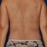 Torso Liposuction Before & After Patient #124