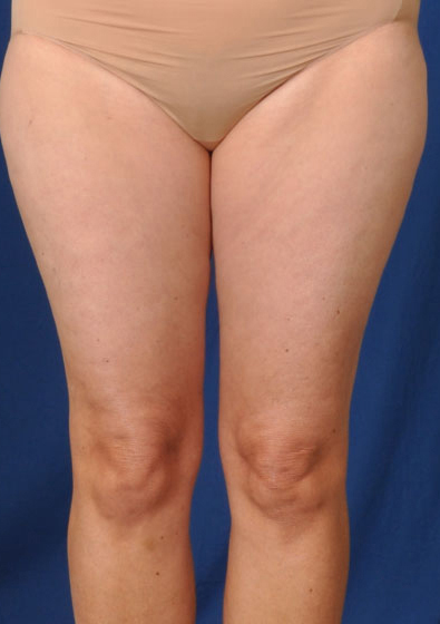 Legs Liposuction Before & After Patient #121