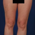 Legs Liposuction Before & After Patient #102
