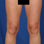 Legs Liposuction Before & After Patient #102