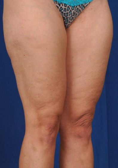 Legs Liposuction Before & After Patient #115