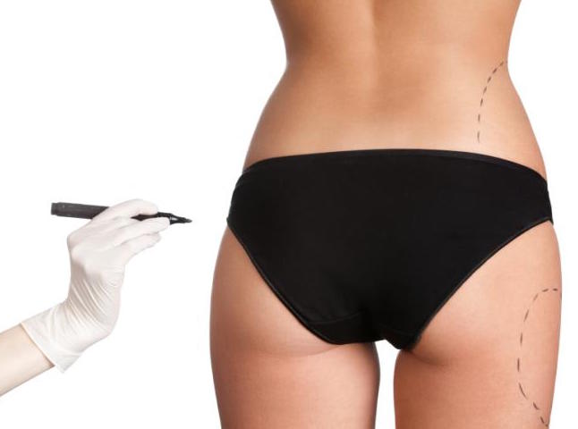 Tummy Tuck Abdominoplasty - Renaissance Plastic Surgery