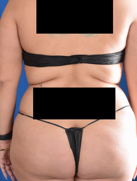 Torso Liposuction Before & After Patient #694