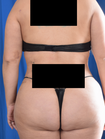 Torso Liposuction Before & After Patient #694