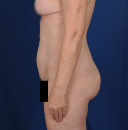 Torso Liposuction Before & After Patient #720