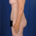Torso Liposuction Before & After Patient #720