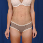 Torso Liposuction Before & After Patient #725