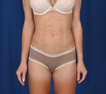 Torso Liposuction Before & After Patient #725