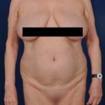 Torso Liposuction Before & After Patient #733