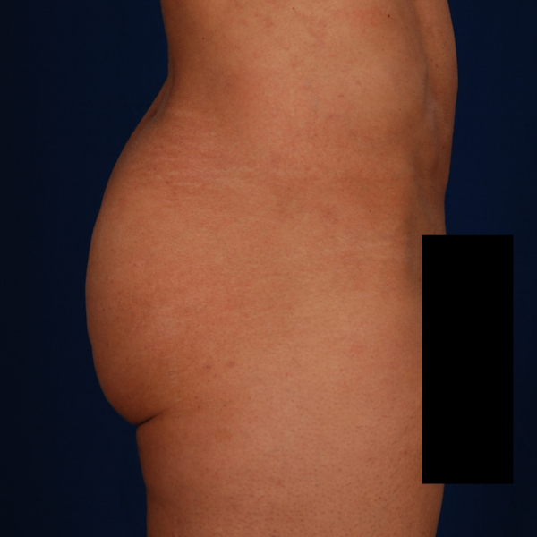 Brozillian Butt Lift (Male BBL) Before & After Patient #775