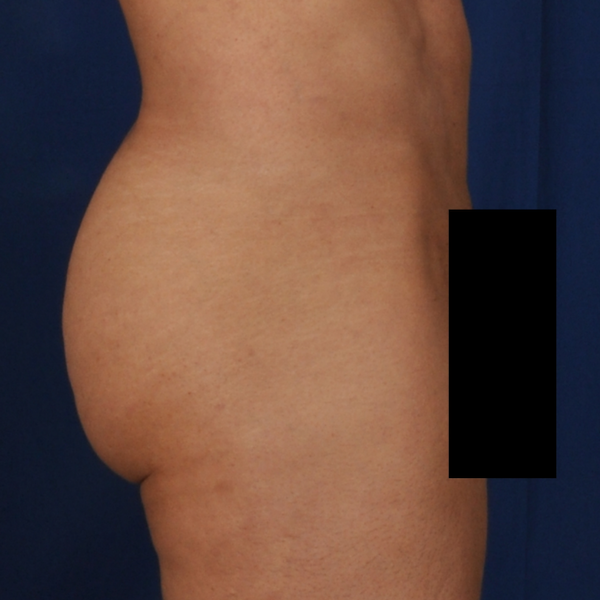 Brozillian Butt Lift (Male BBL) Before & After Patient #775