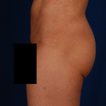 Brozillian Butt Lift Before & After Patient #775