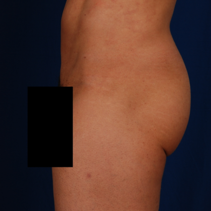 Brazilian Butt Lifts (BBL) Before & After Patient #775