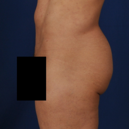 Brazilian Butt Lifts (BBL) Before & After Patient #775